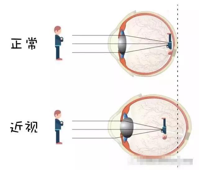 近视是眼在调节松弛状态下,平行光线经眼的屈光系统的折射后焦点落在