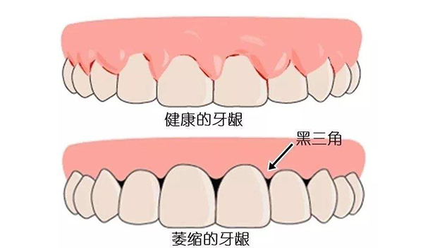 成都牙科医生任欢讲：牙龈黑三角可以恢复吗？