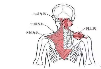 详解颈部肌筋膜性疼痛