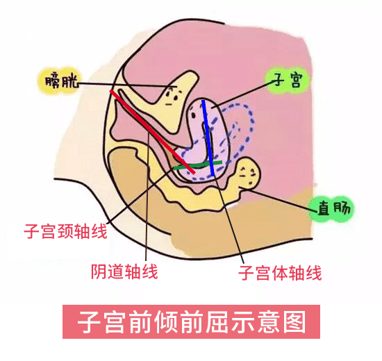 倾角,是指阴道轴线与子宫颈轴线的夹角,小于180°为前倾,大于180°为