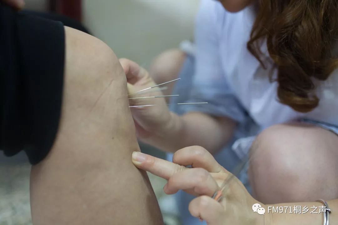 梅雨季正当时腰酸腿痛拔罐针灸帮你来祛湿