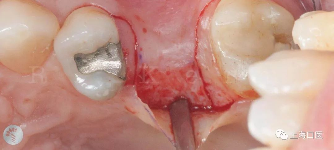 上颌窦区种植牙软组织管理病例分享
