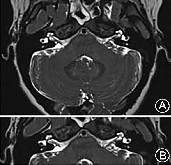 临床检查未见异常.她做了脑和内耳的磁共振成像(mri)检查(图1,图2).