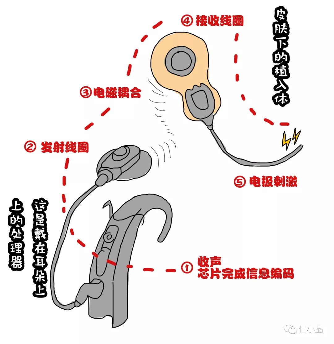 关于人工耳蜗,你想了解的都在这里!