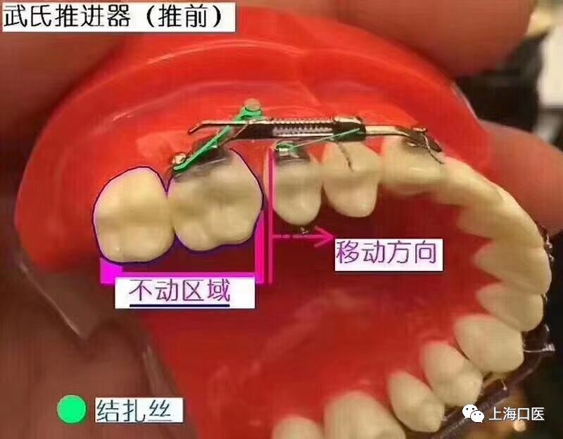 个性化舌侧矫治—武广增教授_推进器