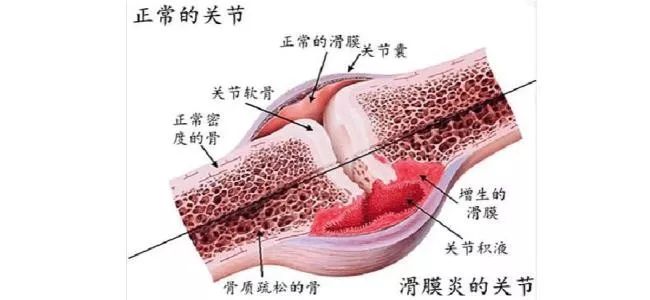 名医专栏丨骨膜炎滑膜炎的诊断