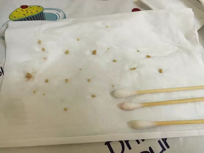 挑眼结石 常戴眼镜or喜欢用手揉眼睛的朋友注意了,眼睛不舒服