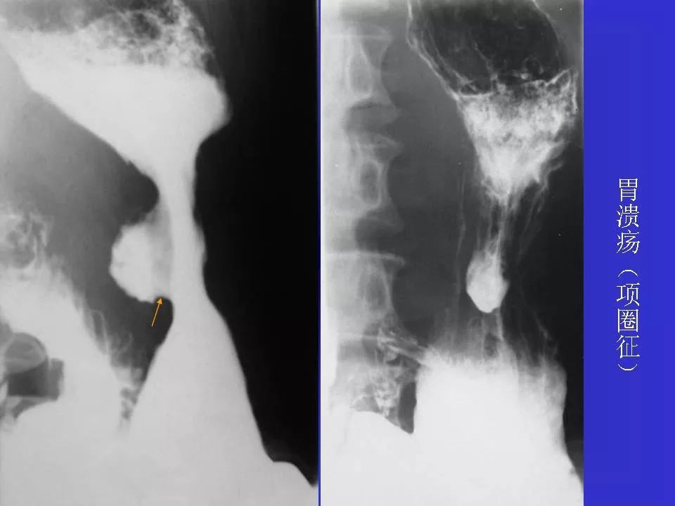 胃溃疡胃癌的影像学表现影像天地