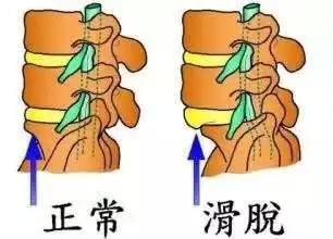 腰椎滑脱症需要手术治疗吗脊柱外科专家余将明告诉你