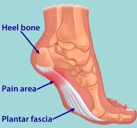 珍藏版脚跟痛最常见的原因足底筋膜炎