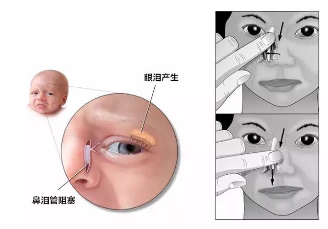 食指向下按压泪囊区几次,然后一边施压向下按,一边沿着鼻泪管向下移动