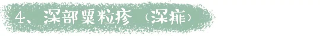                     原创            酷暑难耐的夏天，孩子皮肤频出状况，三招教你搞定恼人痱子！