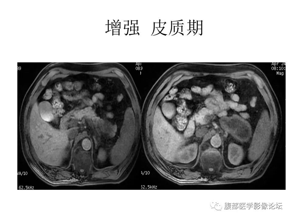 左侧腹膜后神经鞘瘤