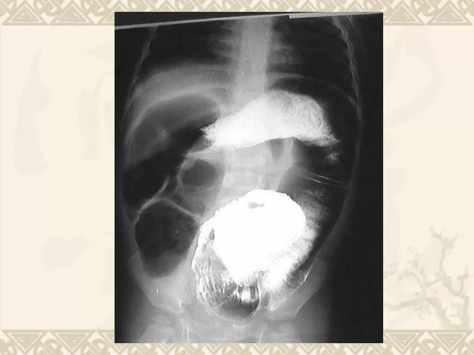 先天性巨结肠的临床与影像学诊断 | 影像天地