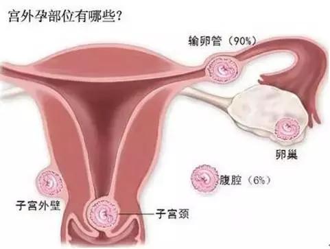 胎膜积血胎儿会怎么样