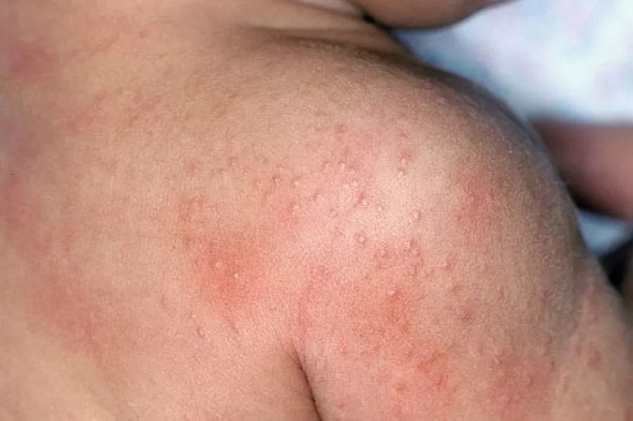 湿疹在任何季节都有可能发生,湿疹是过敏性皮炎的一种,也称为变态