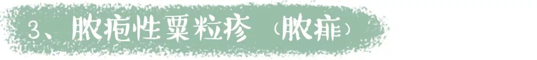                     原创            酷暑难耐的夏天，孩子皮肤频出状况，三招教你搞定恼人痱子！