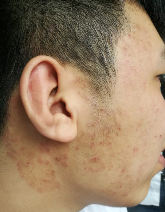 面部皮肤感染致病真菌,主要包括 毛癣菌属,小孢子菌属和表皮癣菌属.