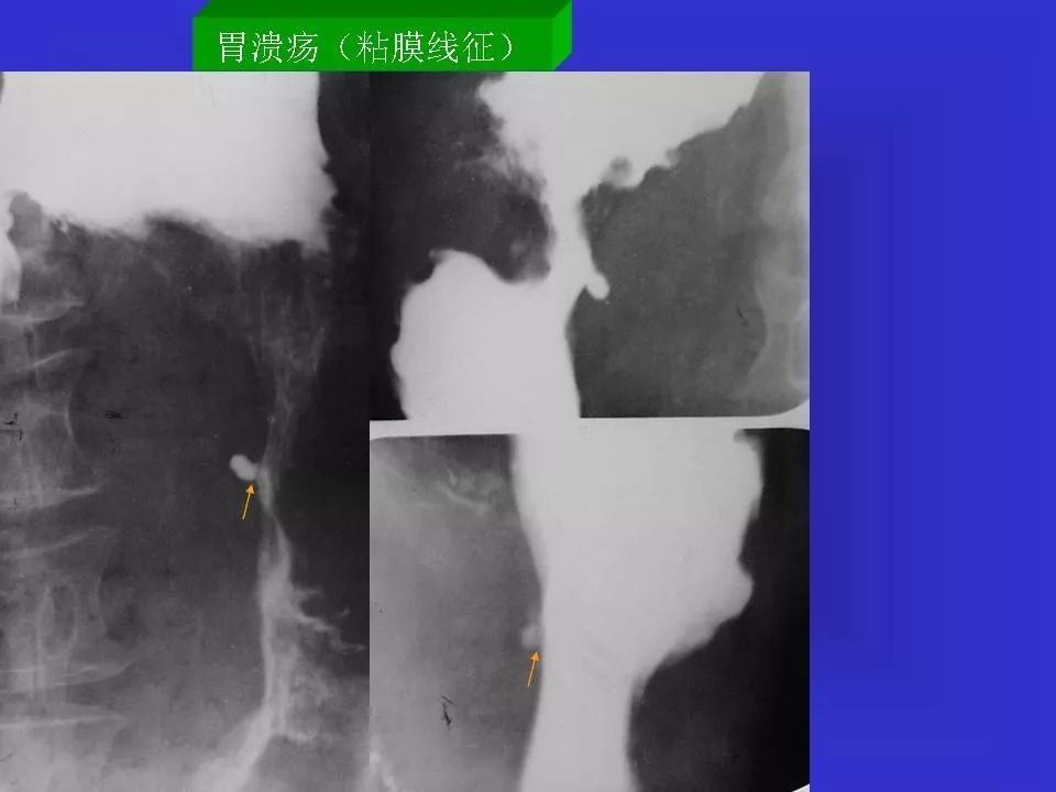 胃溃疡胃癌的影像学表现影像天地