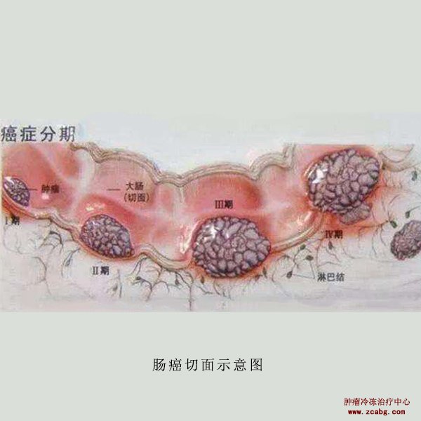 低位直肠癌哪些建议永久造瘘哪些人可做冷冻消融保肛