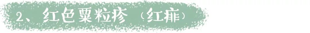                     原创            酷暑难耐的夏天，孩子皮肤频出状况，三招教你搞定恼人痱子！