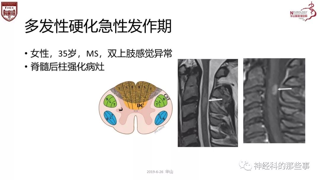 脊髓的解剖和定位诊断