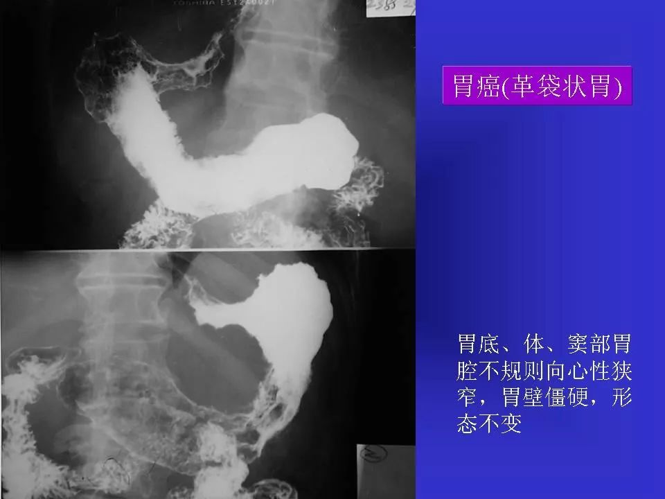 胃溃疡胃癌的影像学表现影像天地