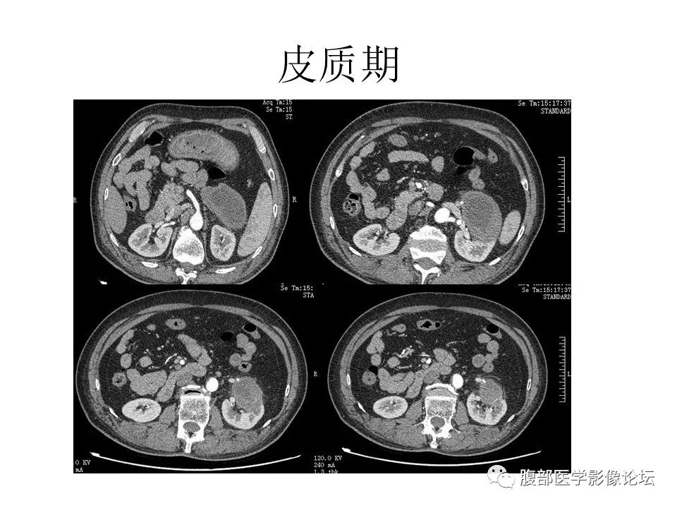 左侧腹膜后神经鞘瘤