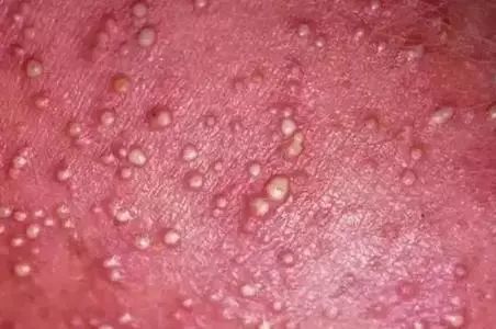                     原创            酷暑难耐的夏天，孩子皮肤频出状况，三招教你搞定恼人痱子！