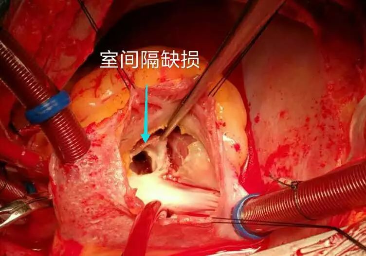 什么是人工心肺机 ed9e594e7e794fcb82369f9f64f995b9.jpeg