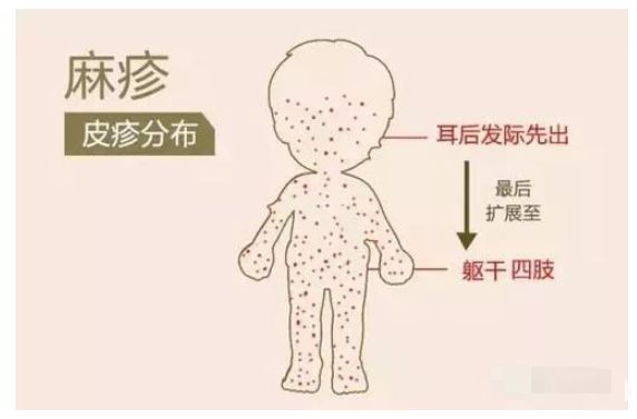 超全收藏手足口病猩红热水痘麻疹如何区别处理