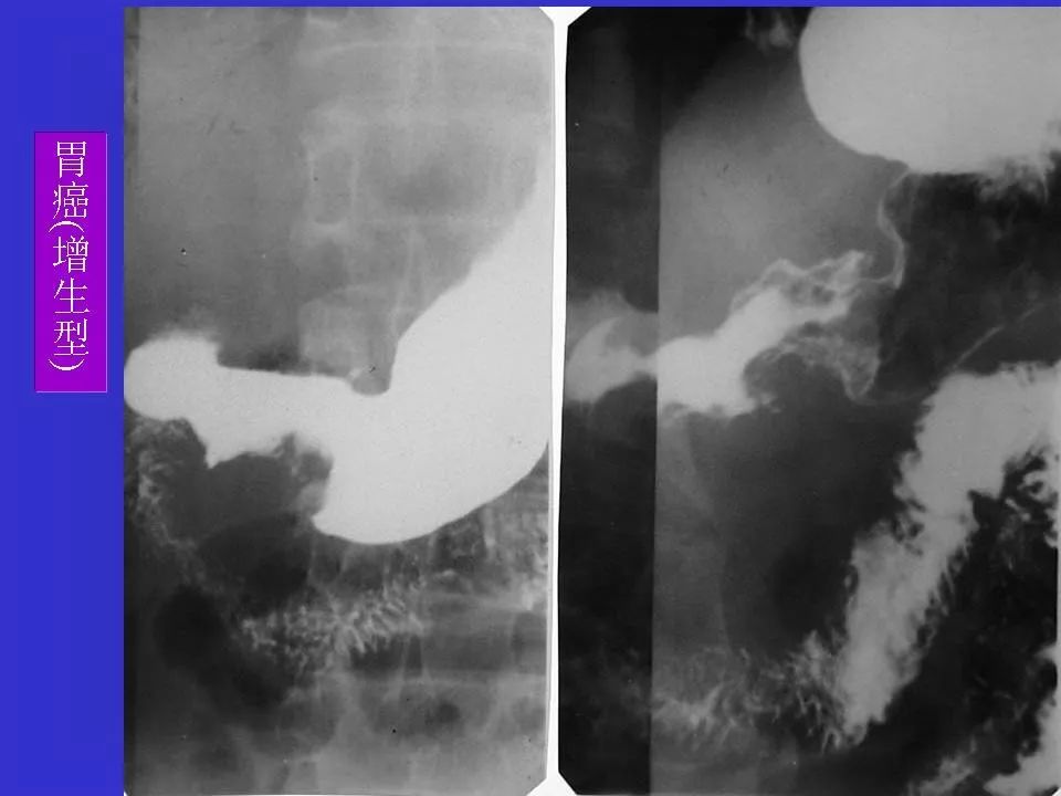 胃溃疡胃癌的影像学表现影像天地