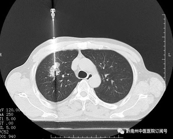 肿瘤科精确穿刺活检术