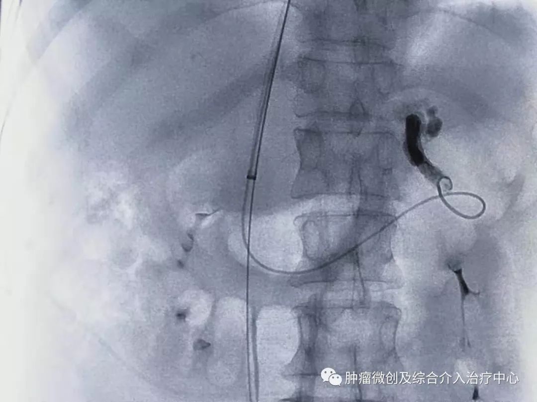 手术过程: 孙惠英主任全程指导