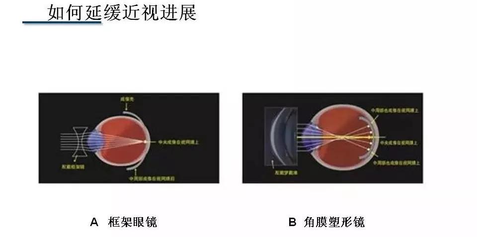 塑形镜的原理_△角膜塑形镜视力矫正原理(3)