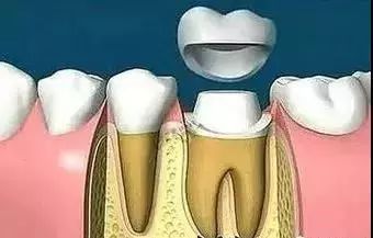 根管治疗后为什么一定要做牙冠?