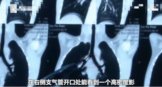                     7岁男童乳牙脱落告知家长，父母竟然不在意，险些卡住气管