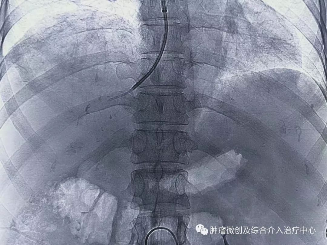 手术过程: 孙惠英主任全程指导