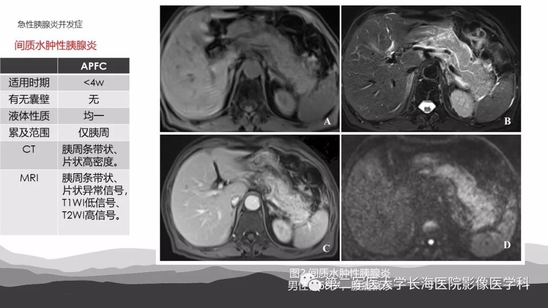 什么是水肿型胰腺炎 1e830a7cd5f1404c8b1a17cb0b1885b8.jpeg