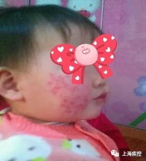 婴儿起湿疹为什么不能打疫苗