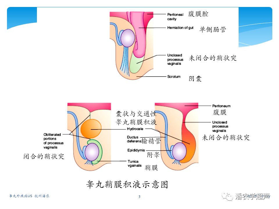 【超声微课堂】睾丸外疾病超声诊断