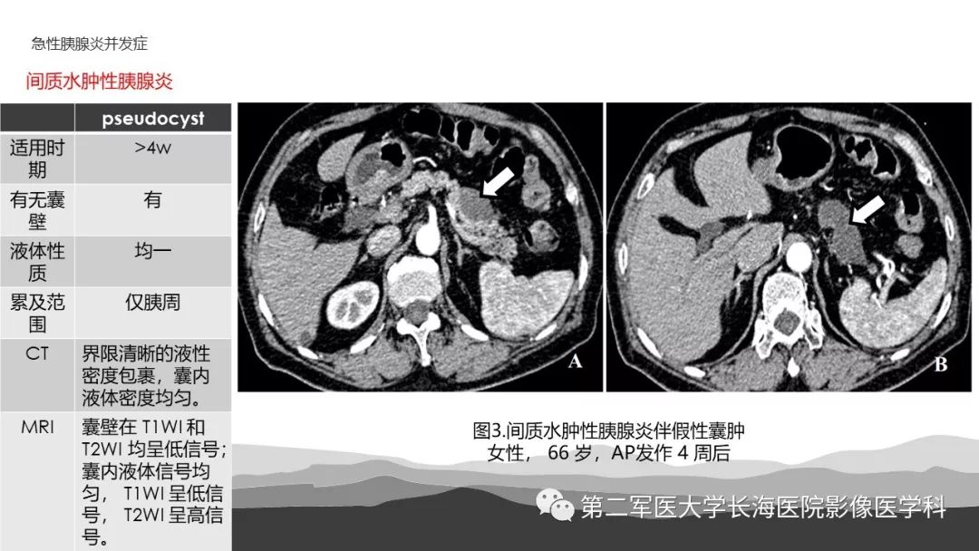 坏死性急性胰腺炎: 诊断,影像,治疗