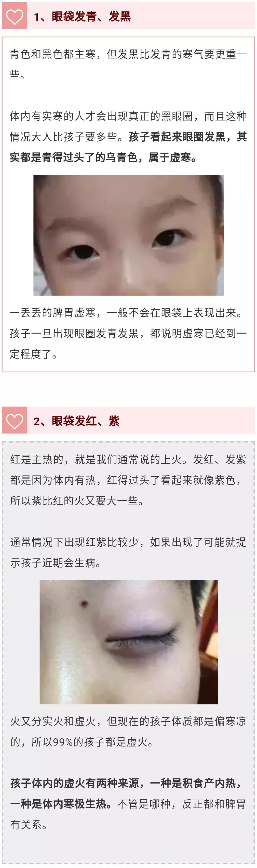                     眼袋的颜色就能告诉你，孩子脾胃如何？大连健儿堂小儿推拿