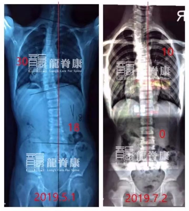 仅仅2个月,12岁男孩脊柱侧弯度数从30°减至10°!