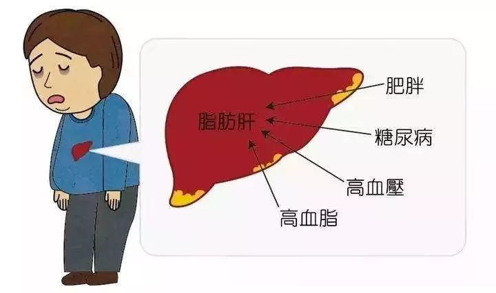 我国居民第一大肝脏疾病"脂肪肝",这10个原因是罪魁祸首!