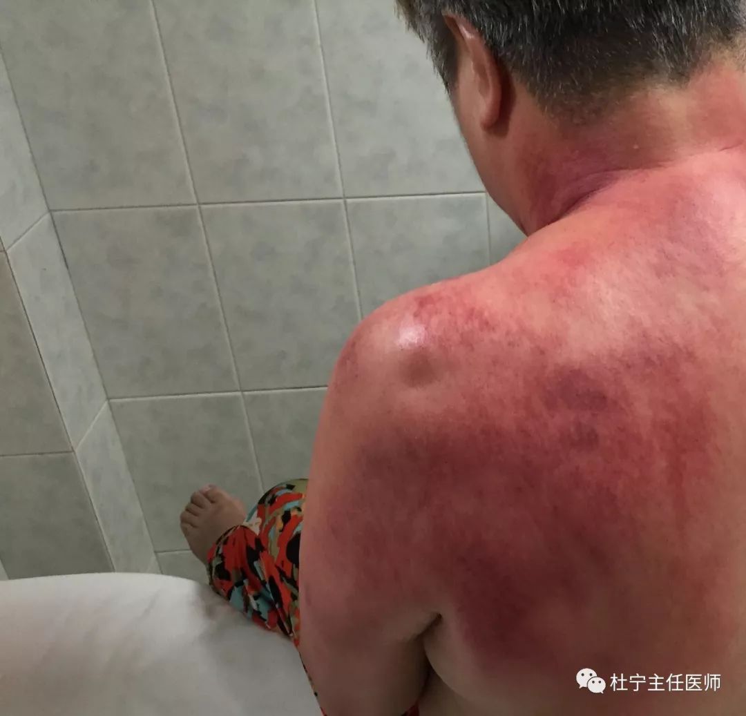 三伏天刮痧防治疾病好处多