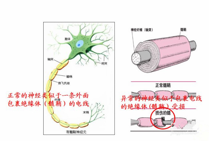 北京辰星中医李慧英医生带你了解脱髓鞘疾病