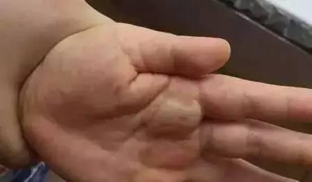                     男童碰到它后手烫掉层皮！这些夏季常见的“街头凶手”一定要远离