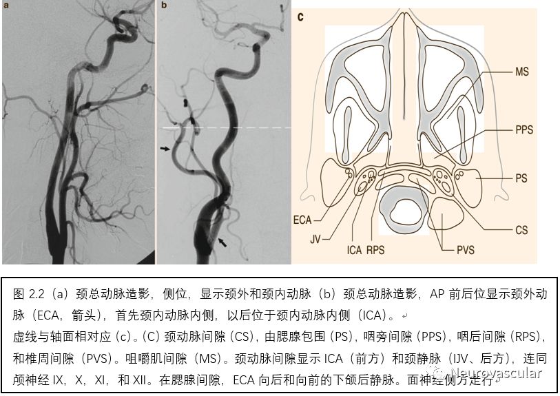 脑血管造影读片基础图谱——颈内动脉,颈外动脉,主动脉弓图谱
