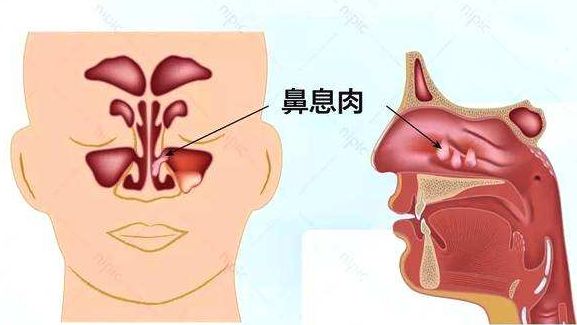 鼻子里长火疙瘩怎么办